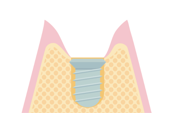 インプラントの挿入