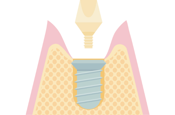 アブトメントの取り付け