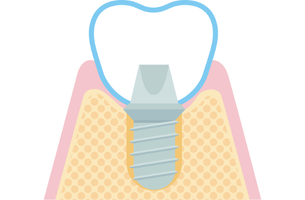 人工歯の取り付け