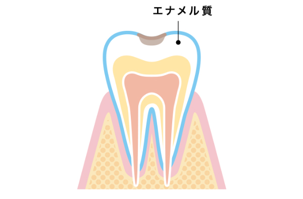 エナメル質の侵食