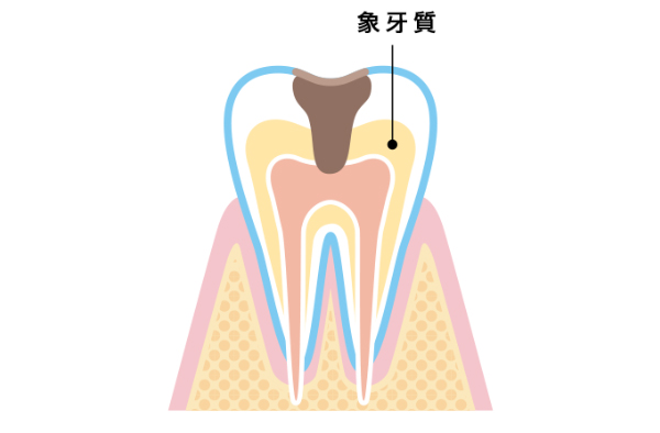 象牙質の侵食