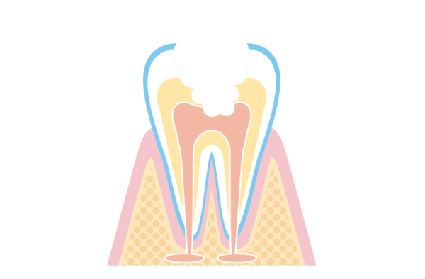 穿孔や感染のリスク