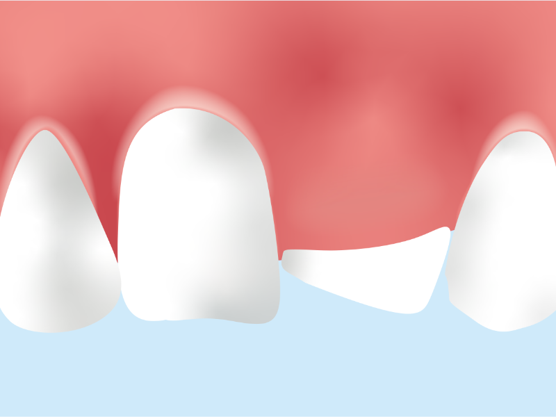 埋伏智歯抜歯・親知らずの抜歯